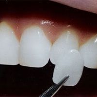 Veneers